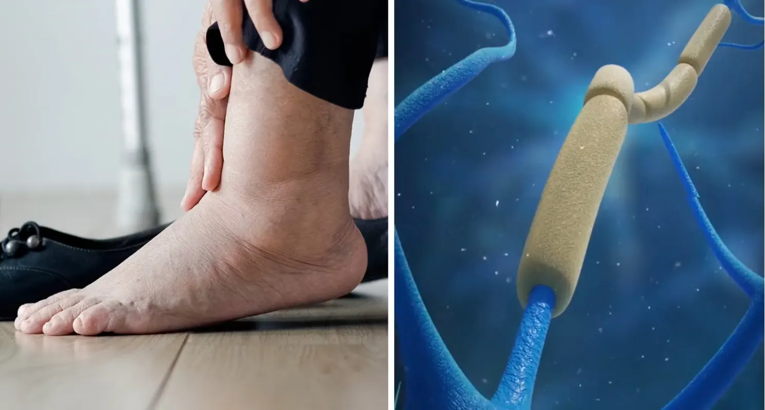 Pieds douloureux et fibres nerveuses endommagées